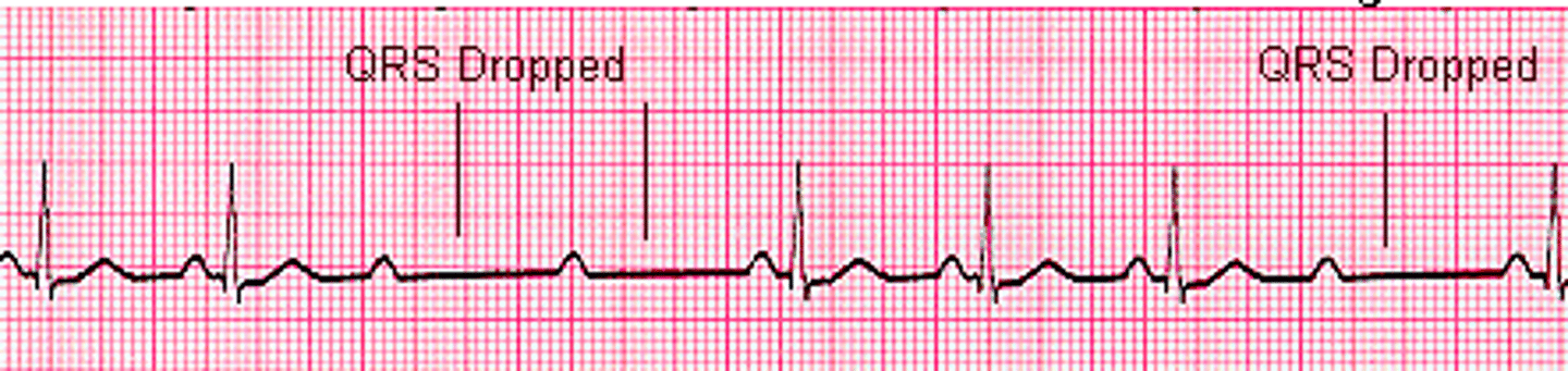 <p>what does this EKG show</p>