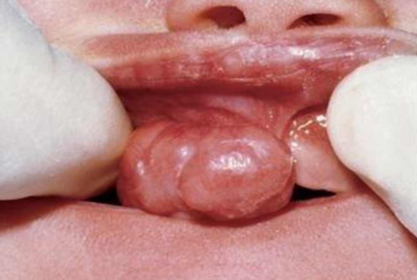 <p>• Uncommon</p><p>• Occurs almost exclusively on the</p><p>alveolar ridges of newborns</p><p>• Bears a microscopic</p><p>resemblance to the granular cell</p><p>tumor</p>