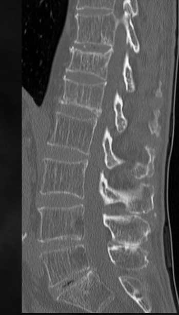 <p>what is seen here for this case of osteoporosis?</p>