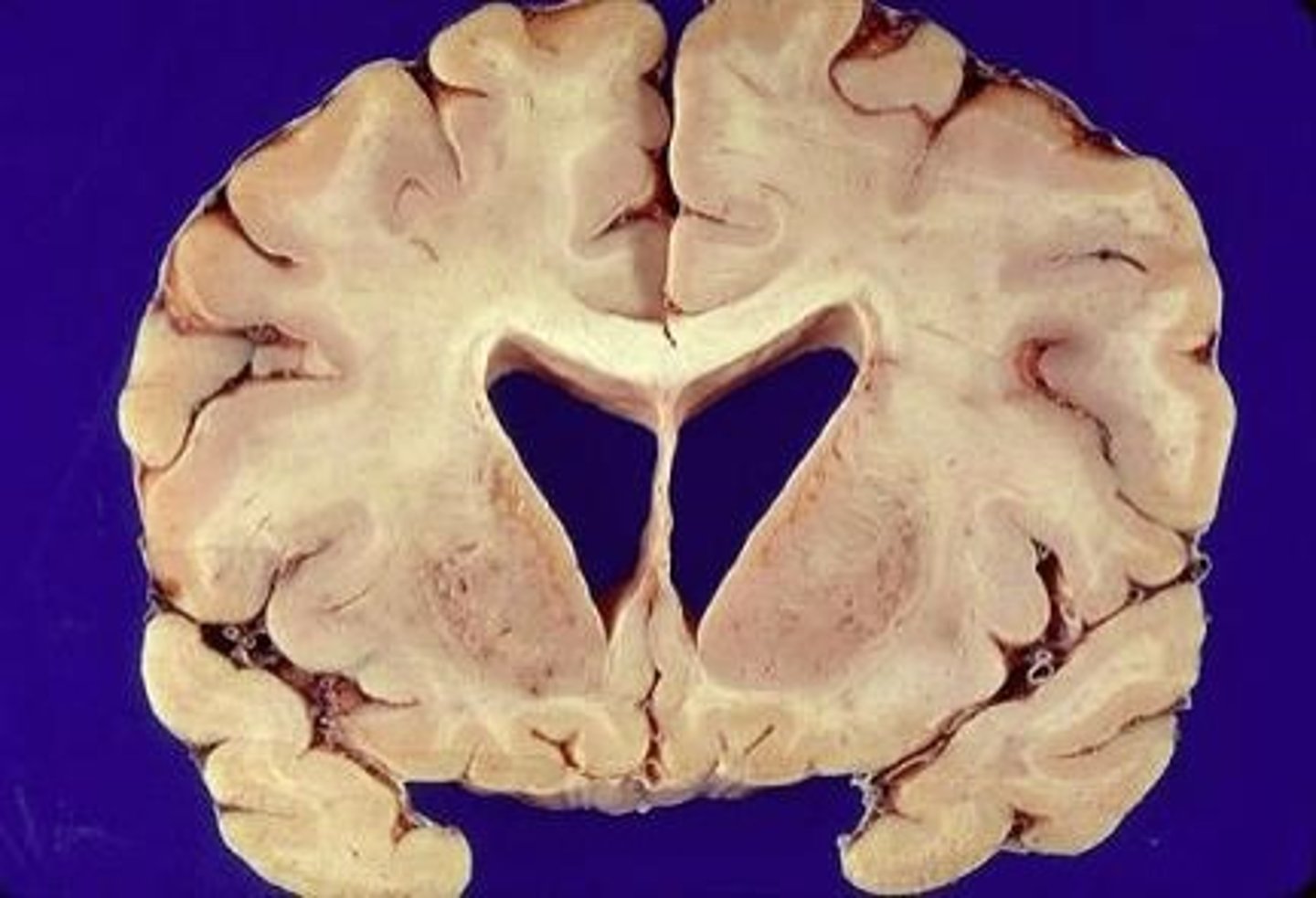 <p>sudden onset of delusions, grandiosity, poor judgment, impulsivity</p>