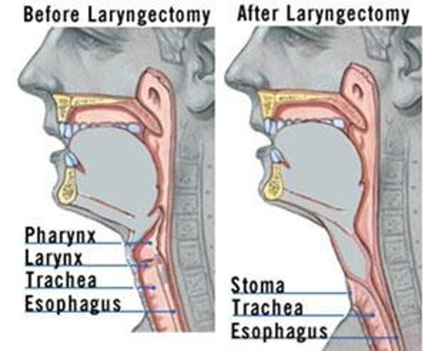 <p>The laryngectomy tube does not have a cuff.</p><p>A cuff is not necessary because food and fluid from the mouth can go only to the esophagus and the stomach, and air going into the laryngectomy tube can go only into the lungs. The only way this patient can aspirate is if a fistula develops because the anatomy has been surgically altered by removal of the larynx.</p>