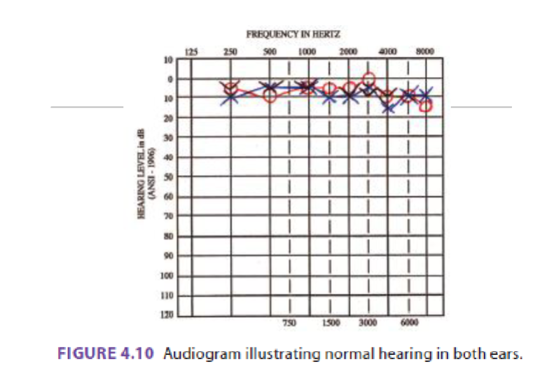 <p>What type of hearing loss is this</p>