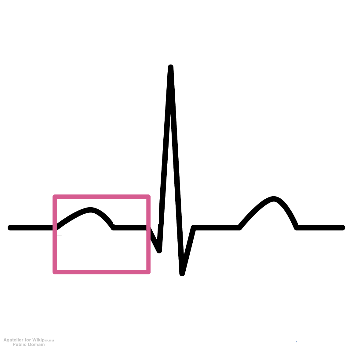 <p>The time period from the beginning of the P wave to the beginning of the QRS complex; indicates the duration of electrical conduction through the atria.</p>
