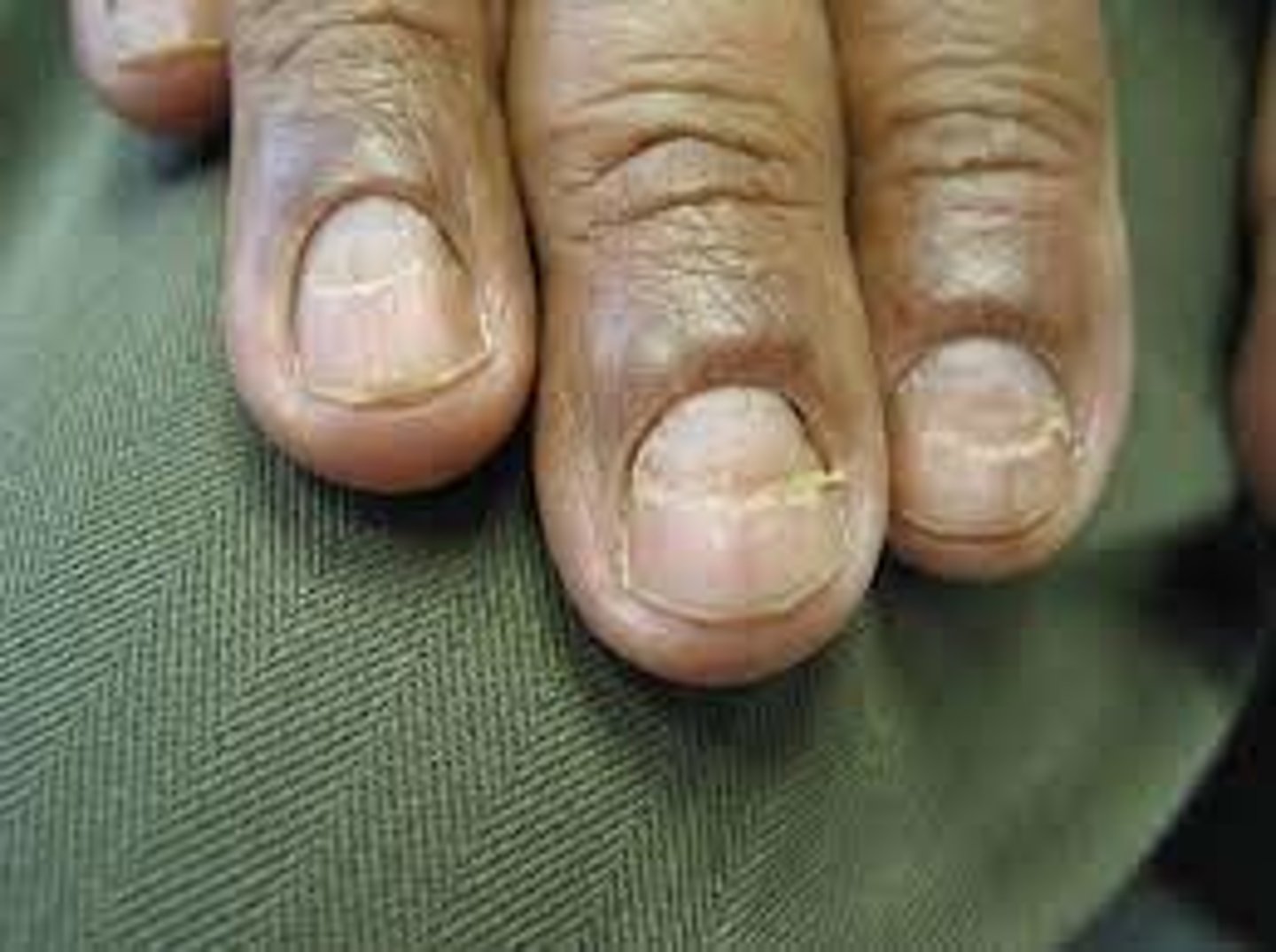 <p>Transverse depressions in the nail</p><p>Causes:</p><p>-Trauma</p><p>-Exposure to cold</p><p>-Raynaud's disease</p><p>-Episodic disease serious enough to disrupt nail growth</p><p>Raynaud's disease:</p><p>-Areas of the body that feel numb or cool</p><p>-When arteries that supply the blood constrict</p><p>-Limits blood supply to extremities</p>