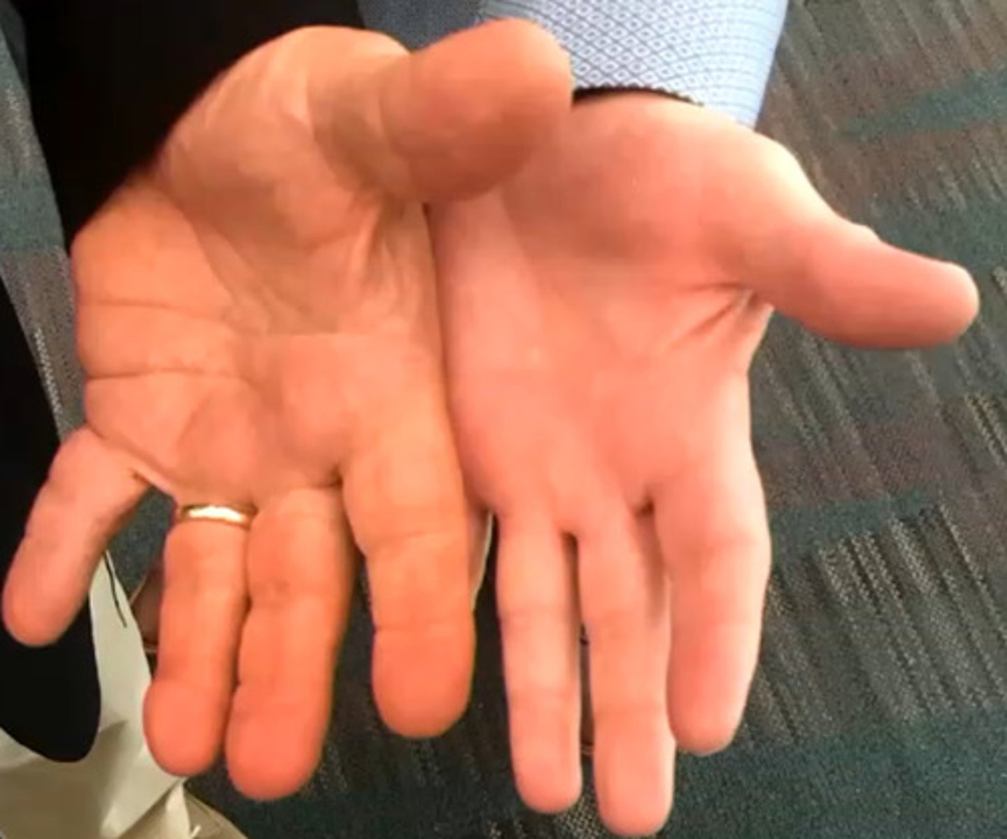 <p>Change in face, hands and feet with smelly sweat</p>