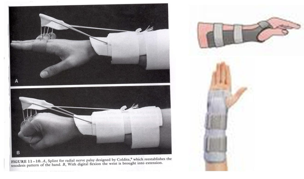 <p>Focus on wrist extension for functional grasp</p>