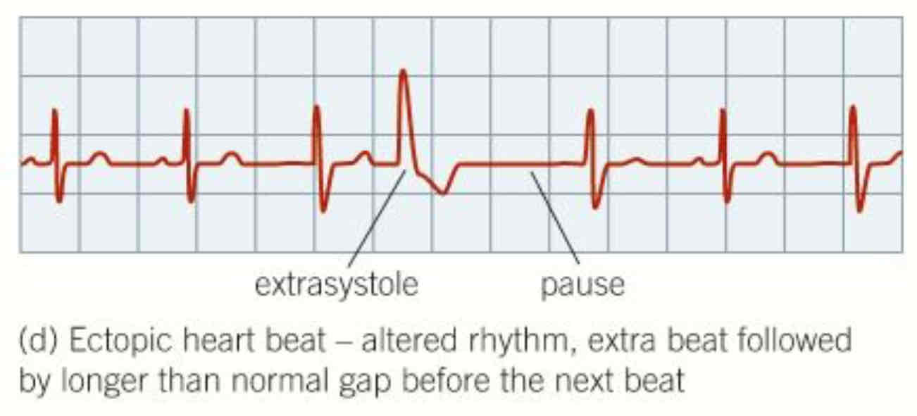 <ul><li><p><strong>extra heartbeat out of normal rhythm</strong></p></li><li><p>usually normal but can be linked to serious conditions when very frequent</p></li></ul>