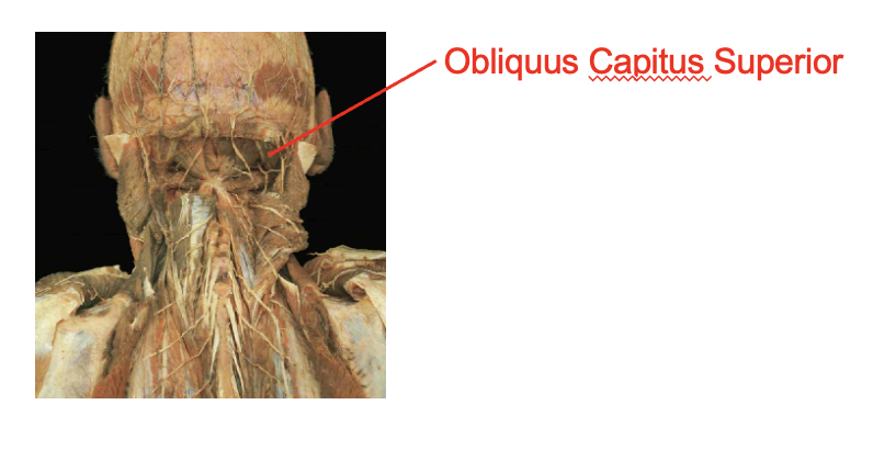 <p>obliquus capitus superior</p><p></p><p>Origin</p><ul><li><p>transverse process of atlas</p></li></ul><p>insertion</p><ul><li><p>occipital bone</p></li></ul><p></p><img src="https://knowt-user-attachments.s3.amazonaws.com/4f812970-167d-4966-8e50-287583198ac6.png" data-width="100%" data-align="center"><p></p>