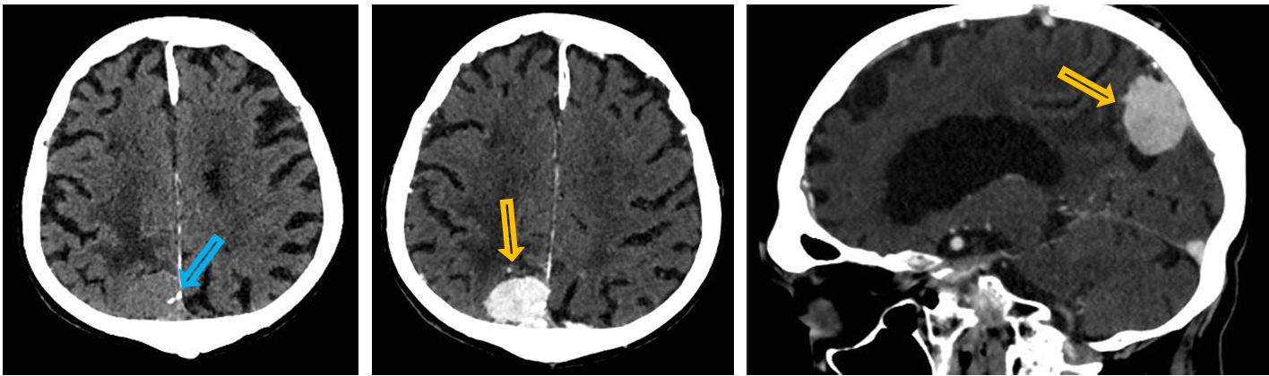 <p>Patient history: epileptic seizure in a middle-aged patient with non-MR-compatible pacemaker Modality: left image – noncontrast CT, axial plane; middle and right images – contrast enhanced CT, axial and sagittal plane (iv. iodine-based contrast agent) </p><p>Region: brain </p><p>Radiologic sign: Right parietal extra-axial mass with small hyperdense calcifications (blue arrow) displaying intensive contrast-enhancement (yellow arrow). The mass exerts external compression on the brain parenchyma. </p><p>Diagnosis: meningioma (most common extra-axial solid mass)</p>