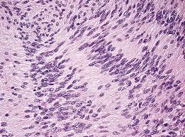 <p>Acoustic neuroma of inner ear</p><p>M/P: Typically show a biphasic appearance with: Antoni A and Antoni B areas. Antoni A Areas: hypercellular areas with the pathognomonic Verocay Bodies Antoni B Areas: hypocellular areas of loose meshwork of Schwann cells.</p>