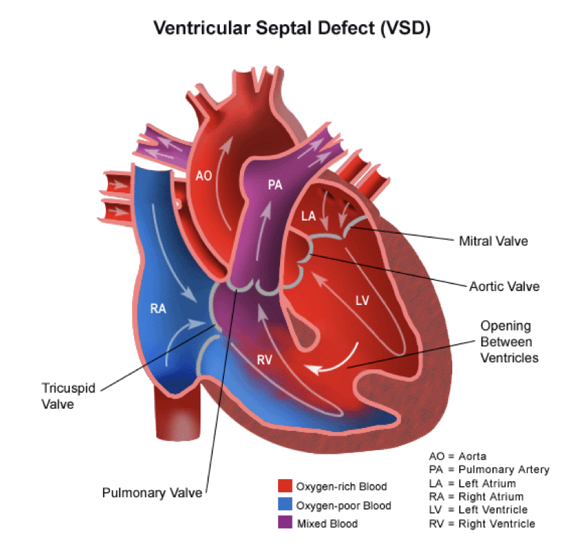 <p><strong>hole between the ventricles</strong></p><ul><li><p>blood flow pathway</p></li><li><p><strong>increased workload on the RIGHT side of the heart</strong></p></li><li><p>size of defect and pressures in the lungs and body determine magnitude of symptoms</p></li><li><p>different types of VSD <strong>based on WHERE THEY ARE IN THE VENTRICLE</strong></p></li></ul><p></p>