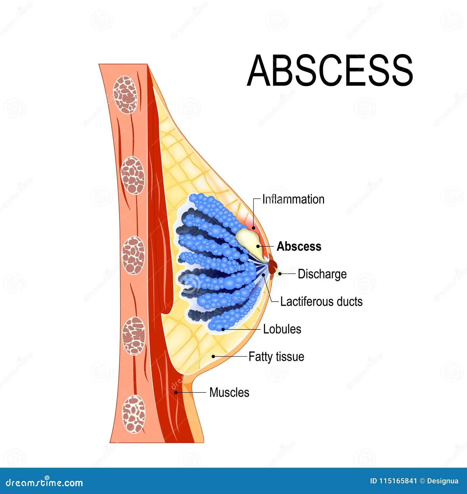 <p>Whats a <strong>Breast abscess</strong>?</p>