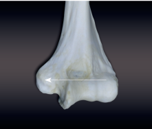 <p>projection above a condyle</p>