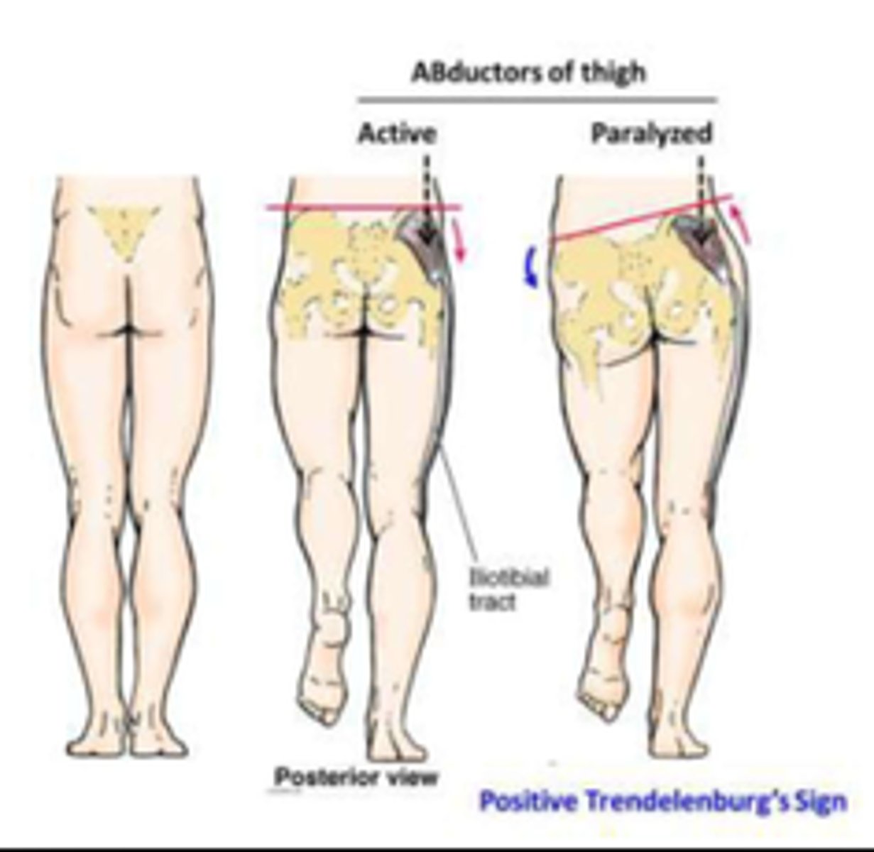 <p>Root: L4-S1</p><p>Cause of injury:</p><p>- iatrogenic injury during intramuscular injection to upper medial gluteal region</p><p>Presentation:</p><p>- Tendelenburg sign/gait --> pelvis tilts because weight bearing leg cannot maintain alignment of pelvis through hip adduction</p><p>- lesion is CONTRALATERAL to the side of the hip that drops, ipsilateral to the extremity on which the patient stands</p><p>Note:</p><p>- the superior gluteal nerve innervates gluteus medius, minimus and tensor fascia latae</p><p>- the inferior gluteal nerve innervates gluteus maximus</p>