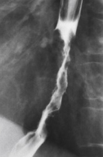 <p>Esophageal carcinoma</p>