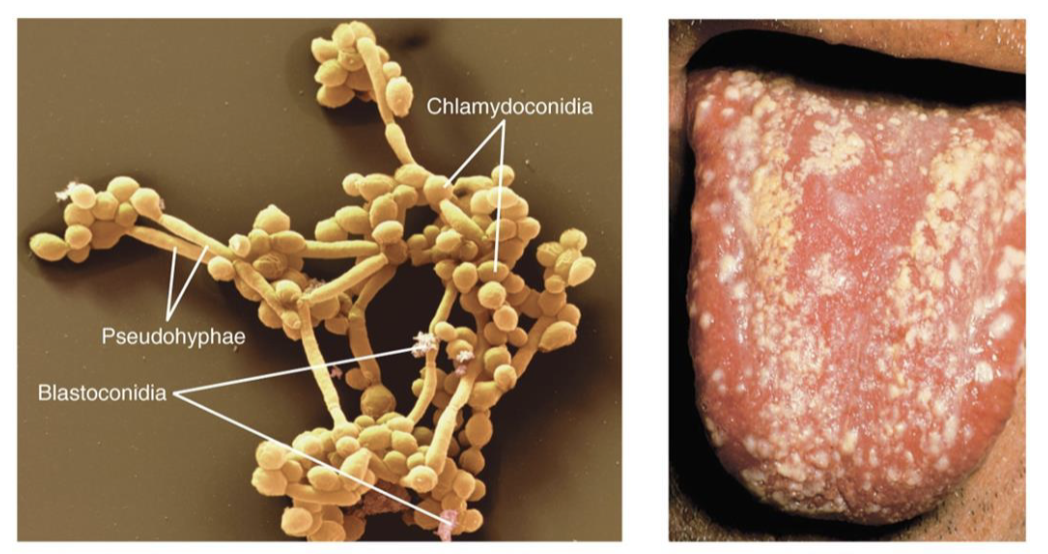 <ul><li><p>fungal skin disease</p></li><li><p>cause: <em>C. albicans</em></p><ul><li><p>part of normal flora in mouth, GI, and vagina</p></li><li><p>virulence: opportunistic</p></li></ul></li><li><p>transmission: direct or indirect contact in hospitals (nosocomial)</p></li><li><p>symptoms: oral thrush, cutaneous and vulvovaginal candidiasis</p></li></ul><p></p>
