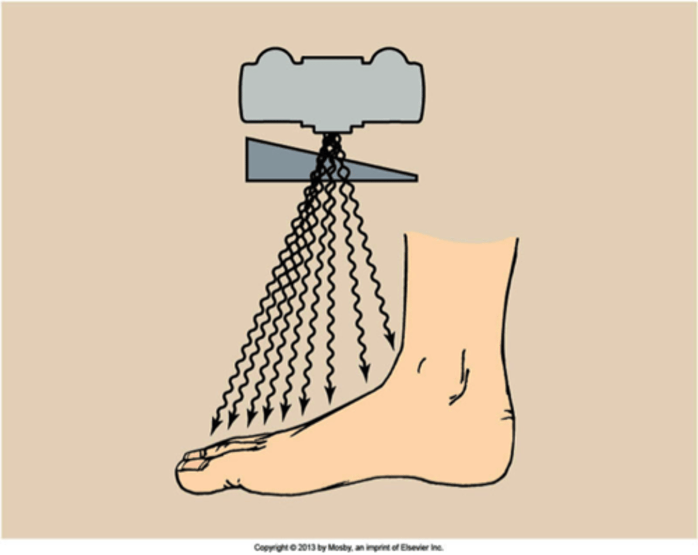 <p>Most common kind of compensating filter which is used to radiograph body parts that vary considerably, such as the foot.</p>
