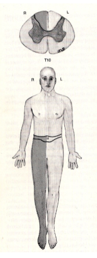 <p>(dorsal column)</p><p>deficit in position sense, vibration sense, discraminatory touch on the same side of body at the level of lesion and below</p>