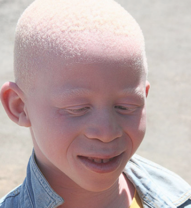 <p>hair, skin and eyes — this is different from ocular albinism which is an X linked hypopigmentation disorder restricted to the eyes </p>