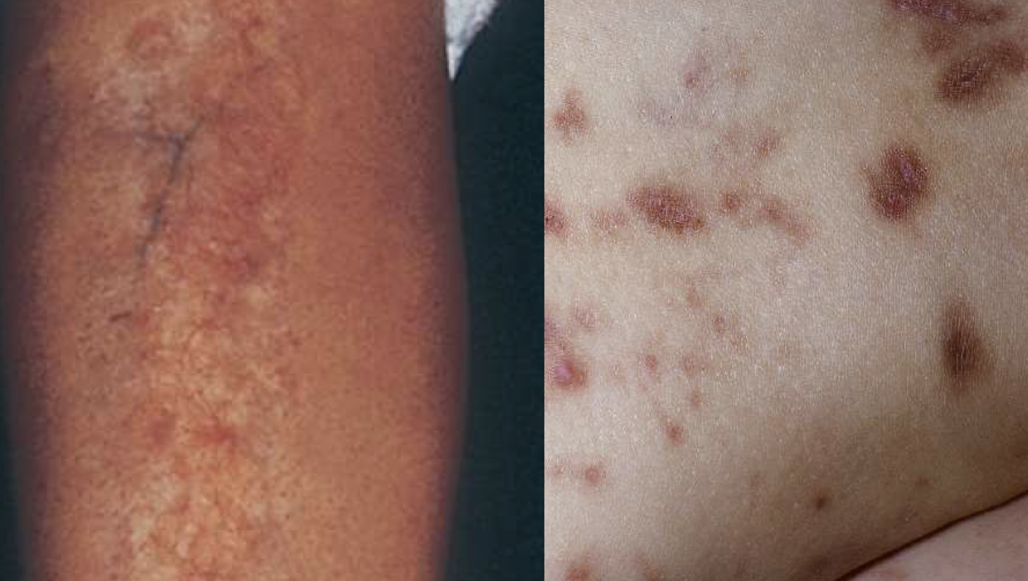 necrobiosis lipoidica on left, diabetic dermopathy on right