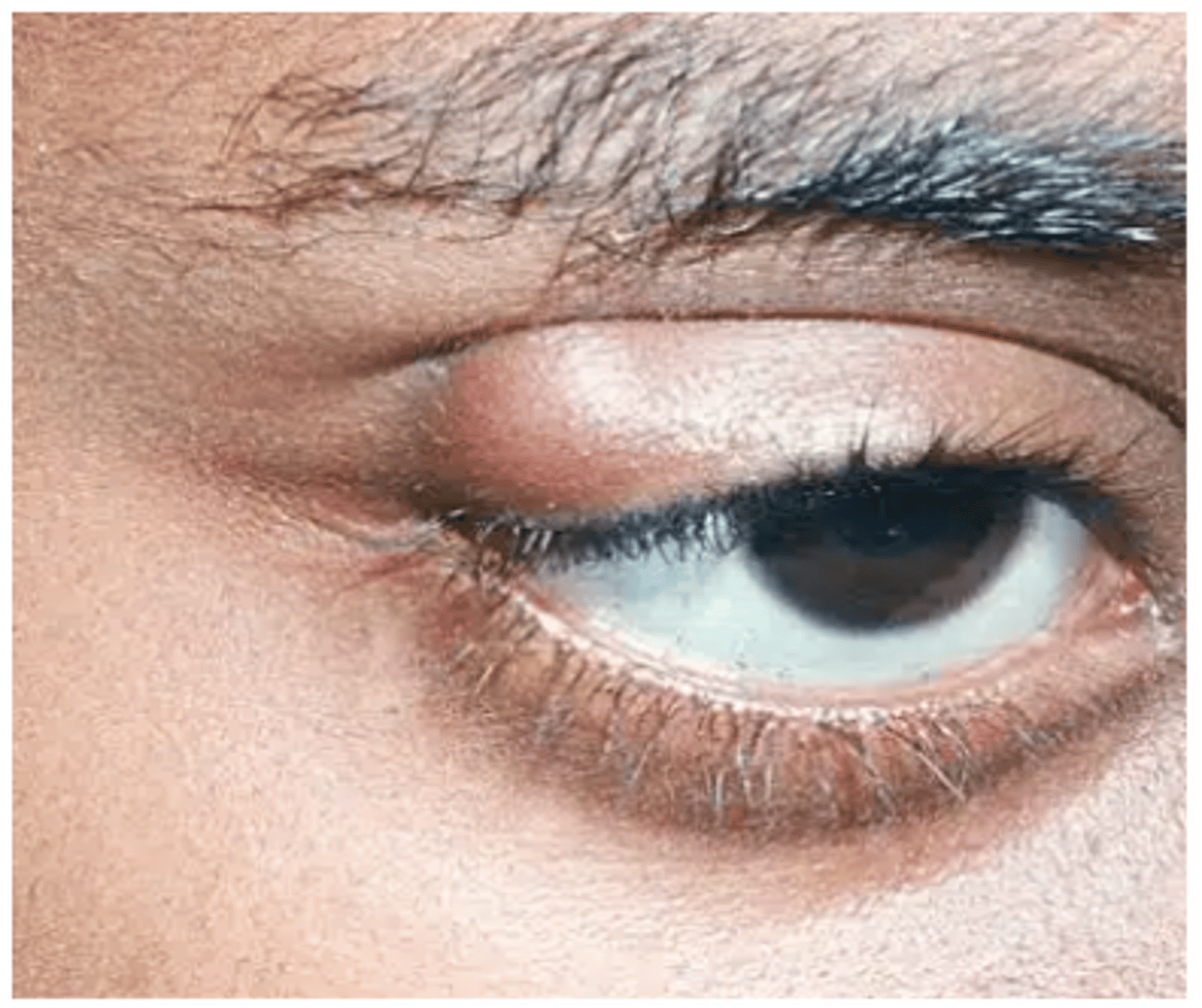 <p>name the eyelid abnormality</p>