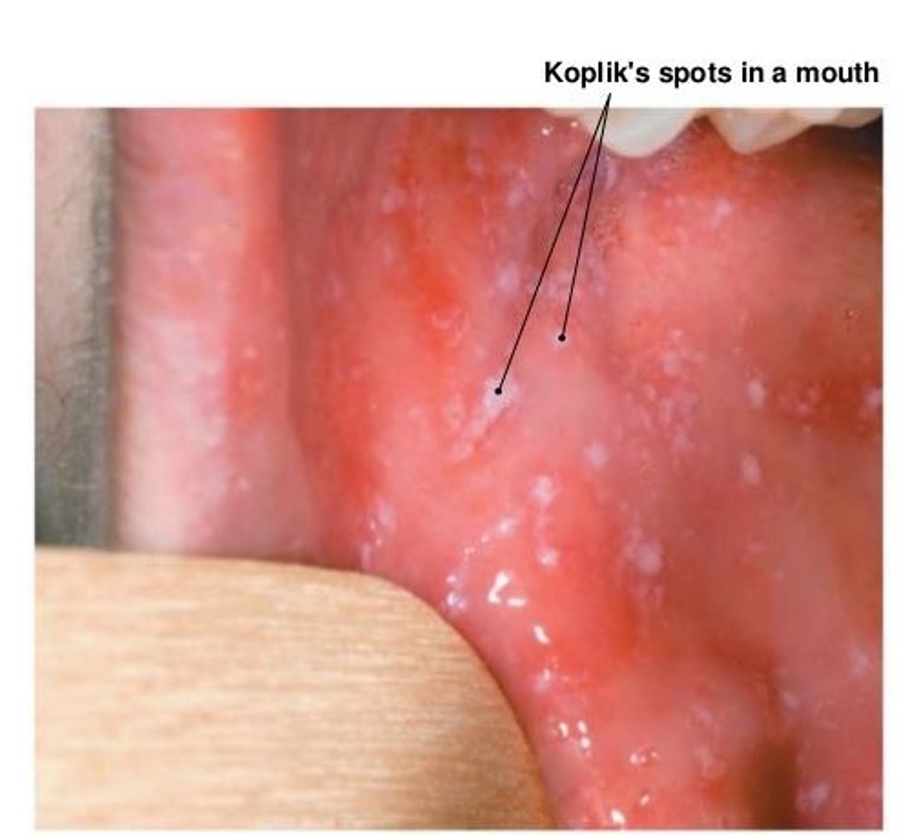 <p>Koplik spots - small white spots in cheek</p>