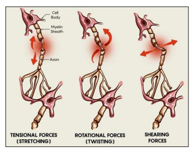 <p>Diffuse axonale aantasting (DAI): axonen stretchen en/of scheuren doordat brein versnelt/vertraagt</p><p>→</p><p>1) Wittestofletsels</p><p>2) Micro-/puntbloedingen</p><ul><li><p>gevolg van schade aan kleine bloedvaten</p></li></ul><p>3) Axonale degeneratie</p><p></p>