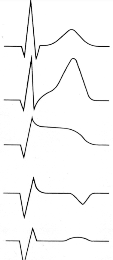 Depending on the location & extent of the infarct, as well as the individual patient's physiology.
