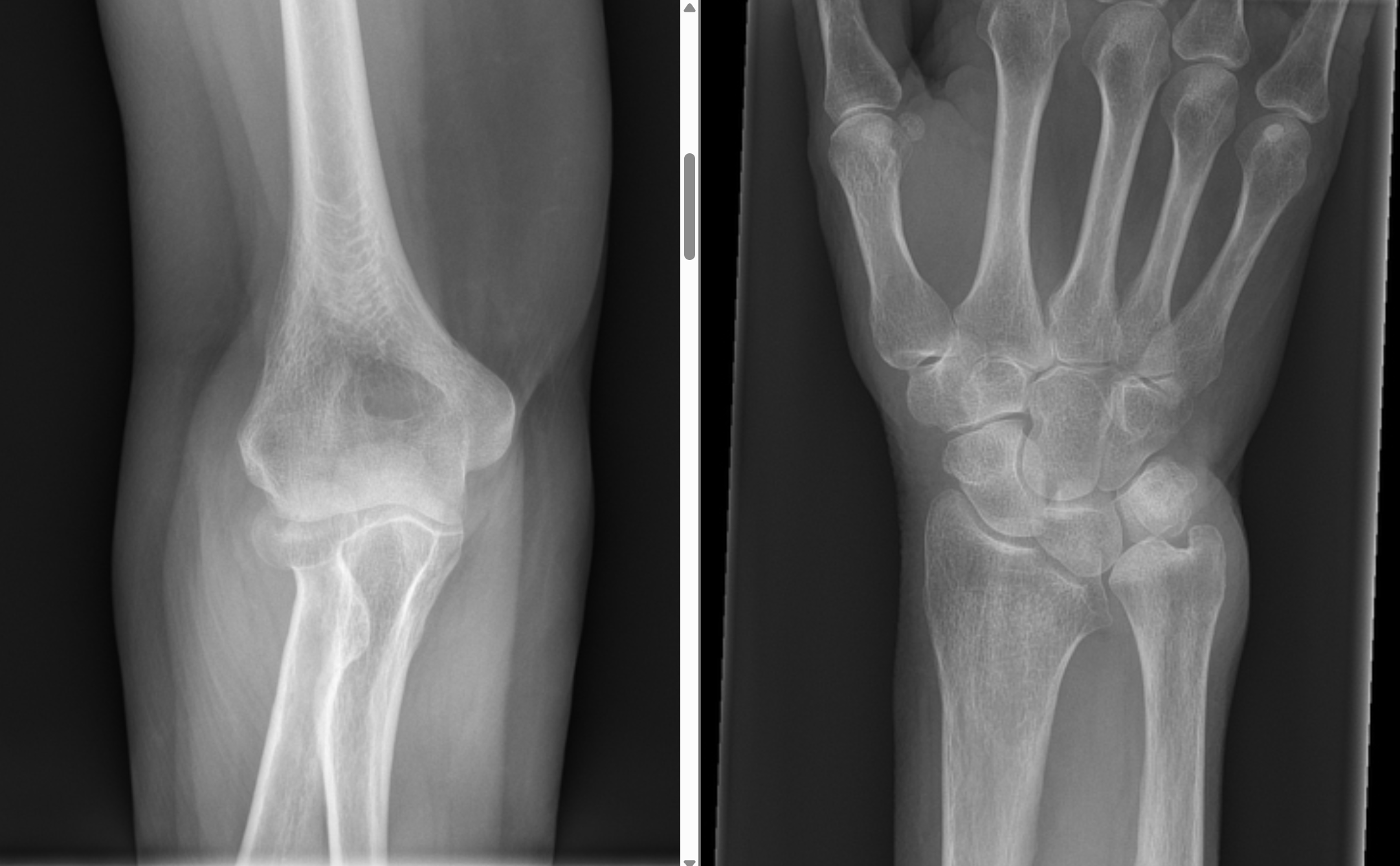 <p>Describe the abnormality demonstrated.</p>