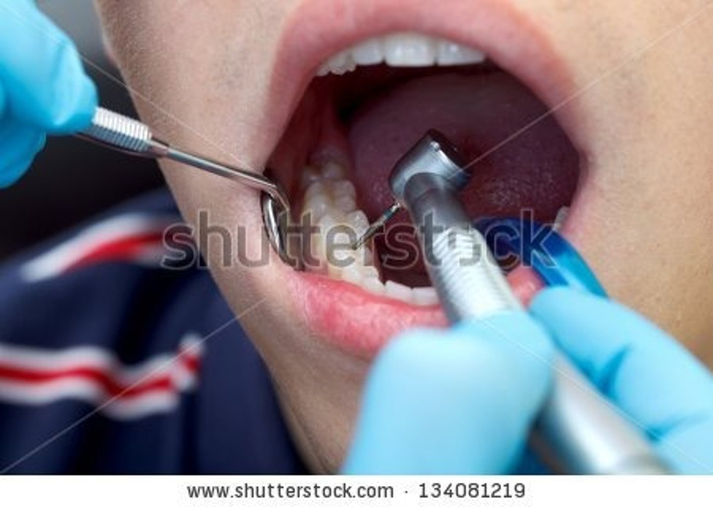 <p>trám răng</p><p>I had a ................... at the dentist's this morning.</p>
