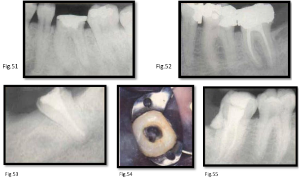 <p>canal anatomy of <strong>mn 2nd molar</strong></p>