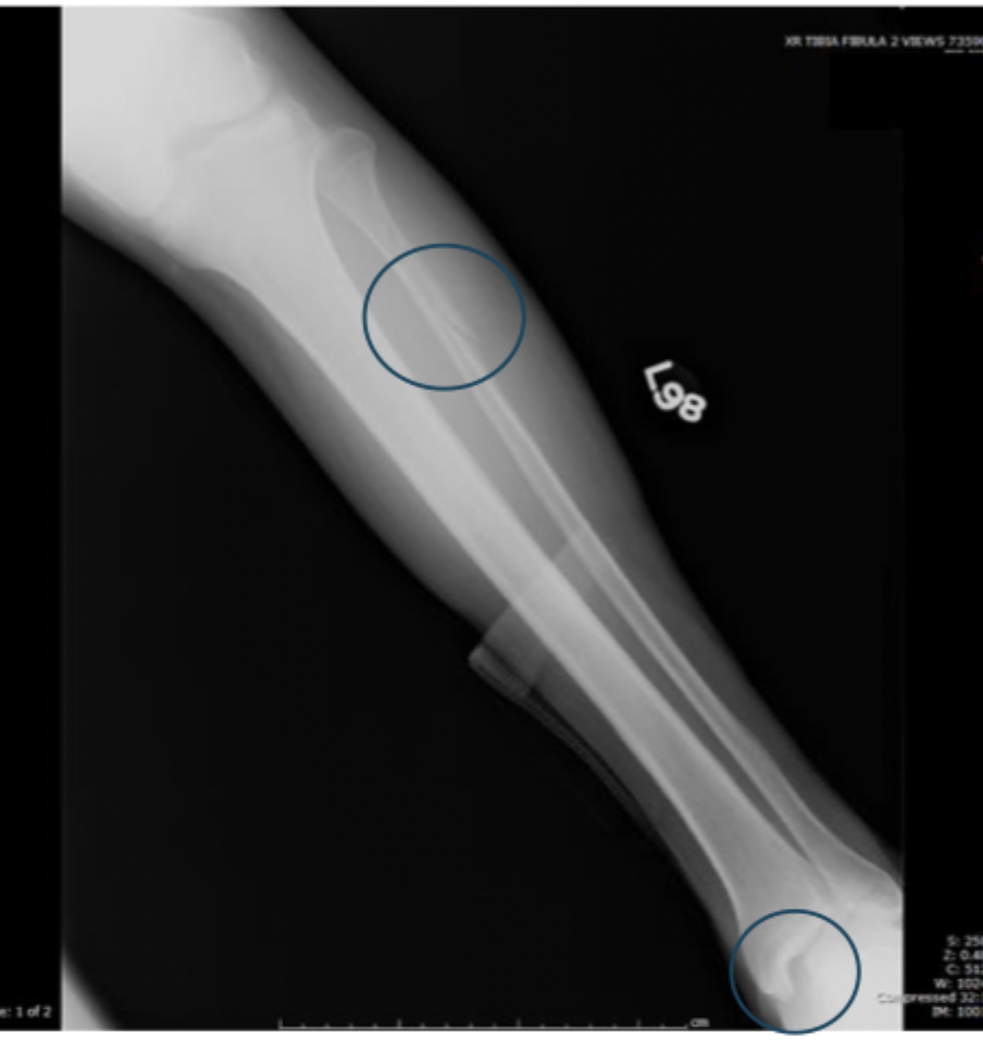 <p>What might you see on exam for Maisonneuve fracture</p>