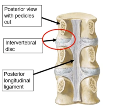 <p>-the PLL is located within the vertebral canal, posterior to the vertebral bodies</p><p>-its structure being narrower than the ALL causes it to provide less support to the intervertebral discs → WEAKNESS</p><ul><li><p>this weakness makes causes the risk of intervertebral disc herniation with posterolateral movement in the areas lacking PLL support</p></li></ul><p></p>