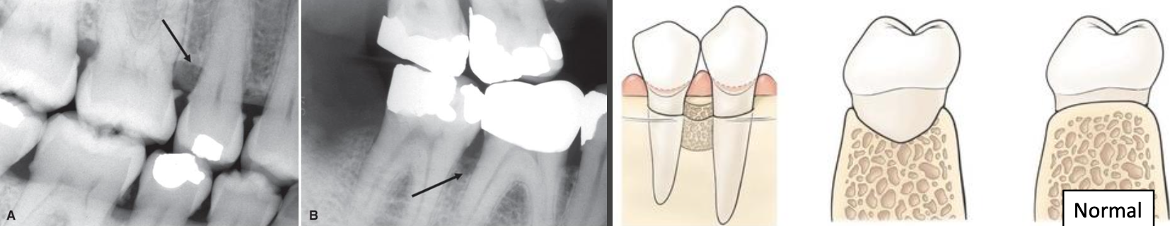 <ul><li><p>2 walled, trough-like defect or depression in crest between teeth</p><ul><li><p>Buccal and lingual cortical walls extend further coronally than resorbed bone between them</p></li></ul></li><li><p>Band-like or irregular region of bone with less density at crest</p></li><li><p>More dense normal bone adjacent to base of crater</p><ul><li><p>More common in posterior segments (broader buccal-lingual dimension)</p></li></ul></li></ul><p></p>