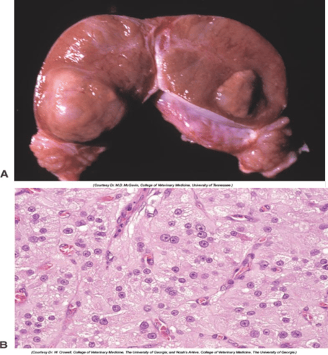 <p>Interstitial (Leydig) cell tumour</p>