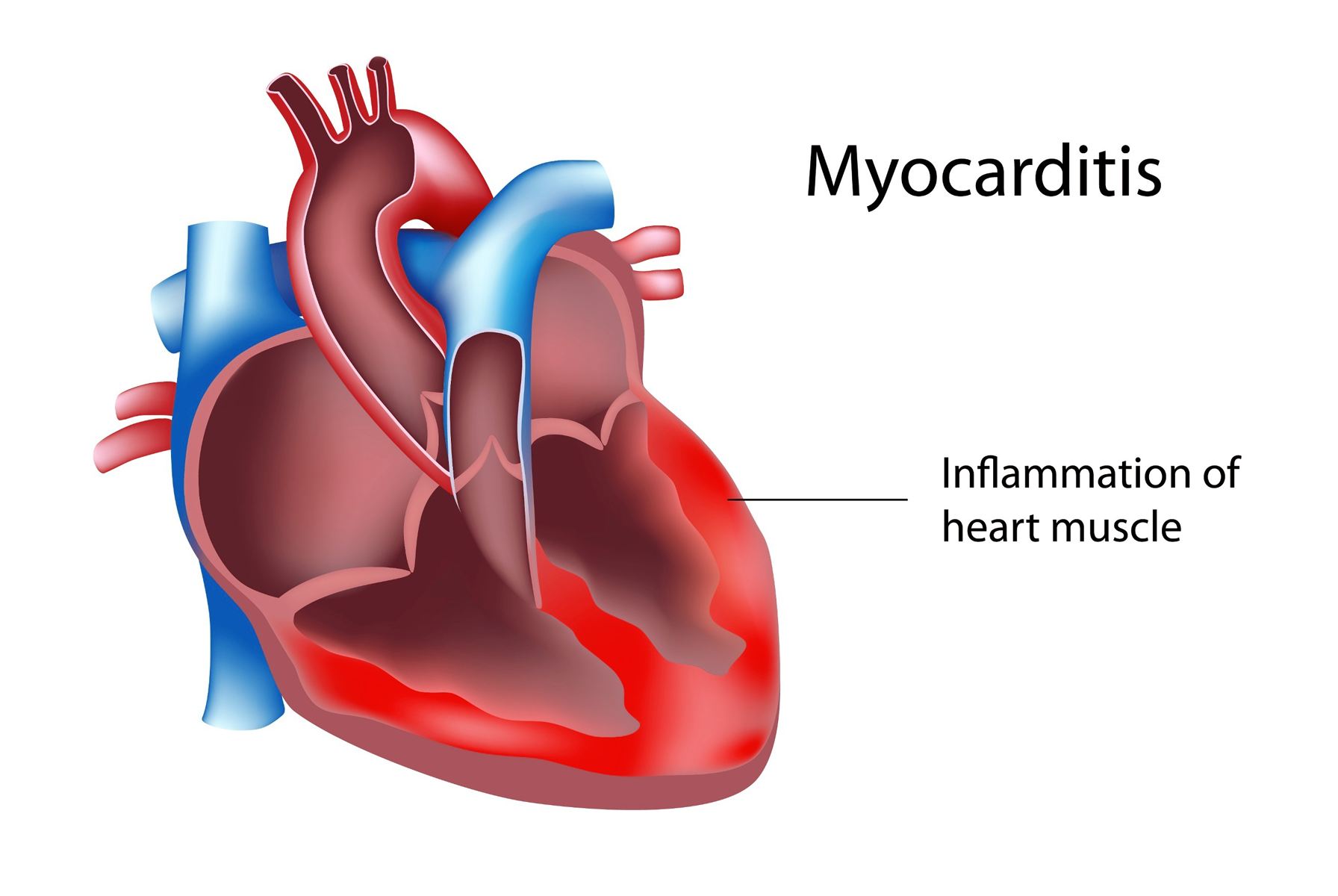 <p><strong>Inflammation of the heart muscle, often due to viral infections, </strong>which can i<strong>mpair myocardial function and mimic symptoms of ACS.</strong></p><p><strong>Yes</strong>, Myocarditis can mimic symptoms of Acute Coronary Syndrome (ACS) due to inflammation of the heart muscle, but it is not caused by blockages in the coronary arteries like ACS.</p>