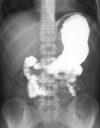<p>What is this x-ray demonstrating?</p>