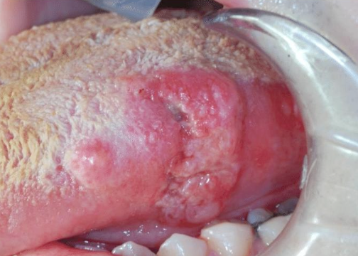 <p>What oral finding should raise concern for SCC?</p>