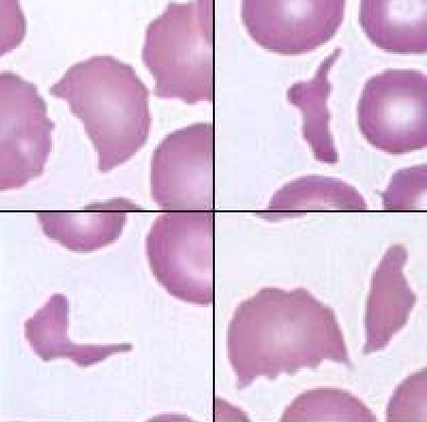 <p>fragmented RBC usually resulting from shearing injury by RBCs traversing intravascular fibrin deposition or abnormal vessels</p>