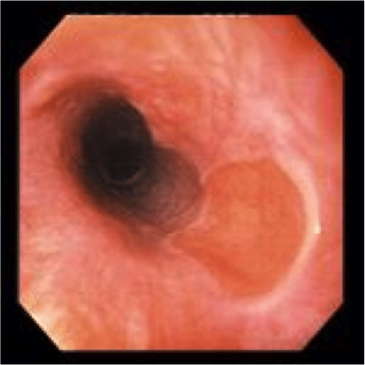 <p>Define Condition:</p><p>Ectopic gastric mucosa is frequently seen in the upper third of the esophagus</p><p>-Associated Hx: (may develop next to these d/t peptic injury)</p><p>&gt; Barrett's esophagus (usually in DISTAL Esophagus)</p><p>&gt; Esophagitis</p><p>&gt; Adenocarcinoma</p><p>-Dx: MUST Biopsy if see Velvety Salmon Mucosa (to r/o dysplastic changes)</p>