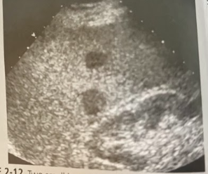 <p>A 77 year old man undergoes a sonography-guided bx after a CT scan. His hx includes a complete gastrectomy 8 months prior for grade IV gastric cancer, and the CT scan today shows multiple liver lesions. The sonogram reveals hypoechoic lesions in both lobes of the liver. What is the bx most likely to show?</p>