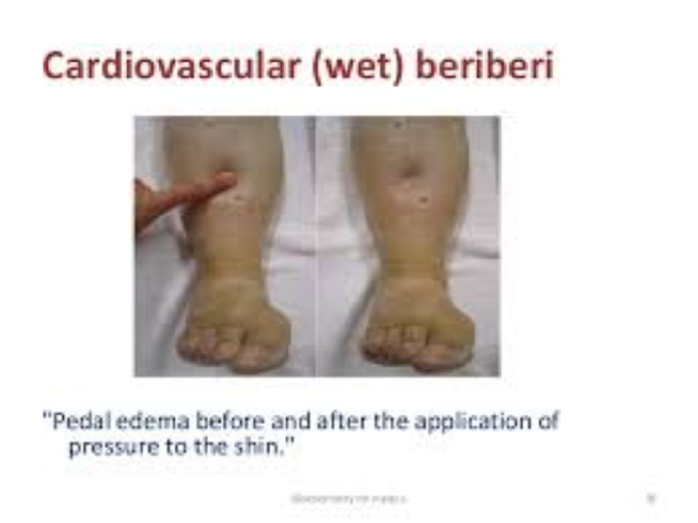 <p>1) Dry beriberi = peripheral neuropathy, bilateral tender calf muscles, symmetrical foot drop (often due to low thiamin + high carb intake)</p><p>2) Wet beriberi = enlarged heart, rapid heartbeat, peripheral edema, & high blood pressure</p><p>3) Acute beriberi = chronic infant deficiency* (2-5 months of age); breast fed mothers with poor thiamin intake</p>