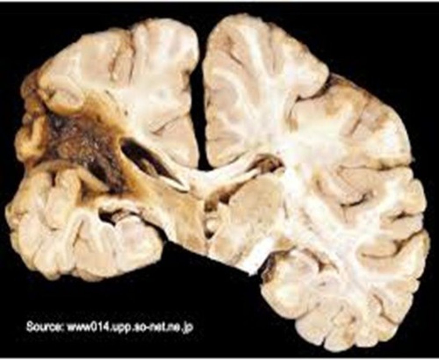 <p>Tissue death due to lack of blood supply.</p>