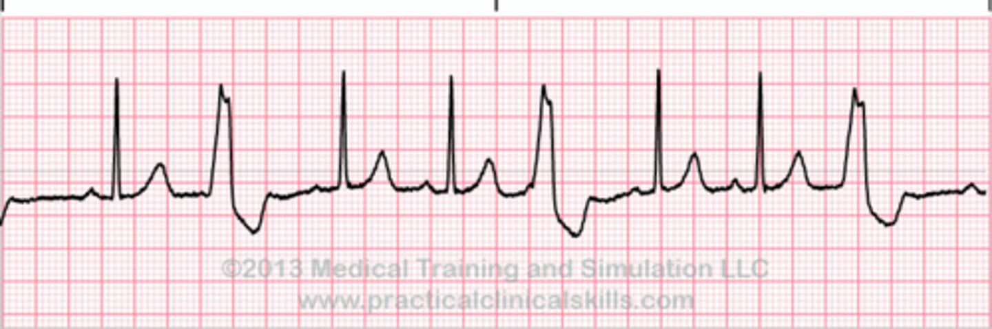 <p>PVC occurs every THIRD beat</p>