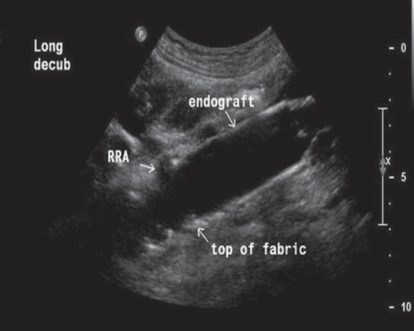 <p>Endovascular Aortic Aneurysm Repair</p><p>Minimally invasive procedure</p><p>Treats AAA's using a stent graft</p><p>Excludes aneurysmal sac from circulation to reduce rupture risk</p>