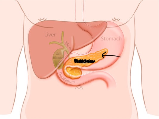 <p>Located partially behind the stomach in the abdomen, acts both as an exocrine and an endocrine gland.</p>