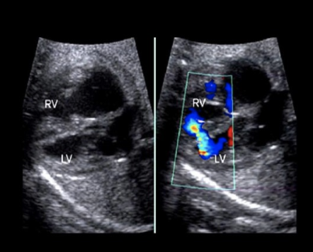 <p>what view of the fetal heart is preferred to evaluate a possible <strong>muscular VSD</strong></p><p>.</p><p>a) 4 chamber view</p><p>b) 3 vessel view</p><p>c) short axis of LV</p><p>d) LVOT view</p>
