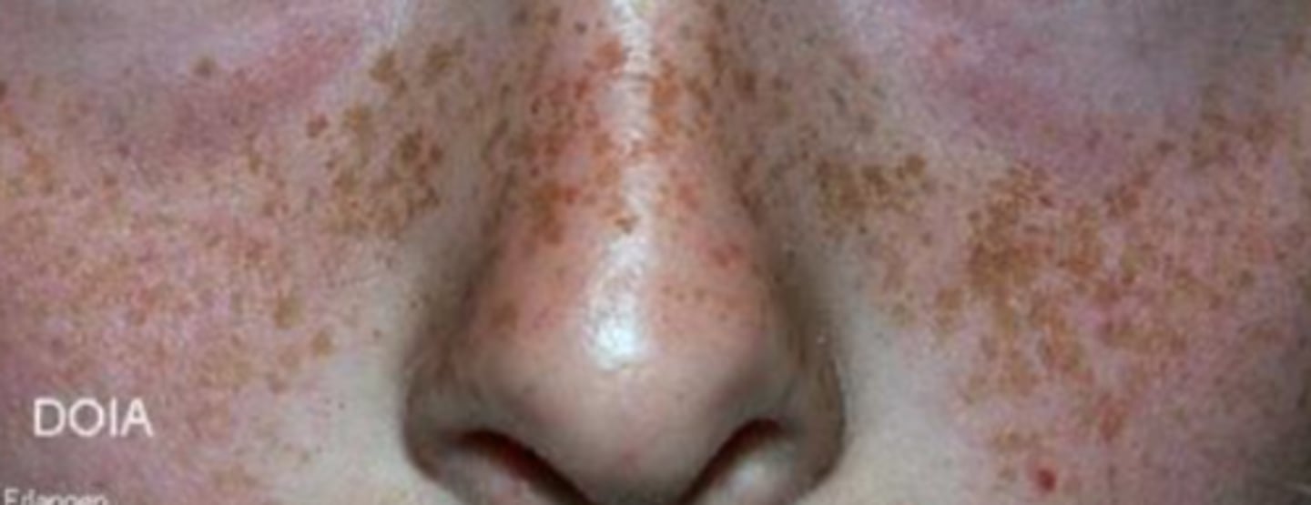 <p>which type of pigmented lesion:</p><p>• Focal area of increased melanin</p><p>• NOT an increase in number of</p><p>melanocytes</p><p>• More pronounced after sun</p><p>exposure</p><p>• Common</p><p>• Become less prominent over</p><p>time</p><p>• Does not occur in the mouth</p><p>• &lt;0.3 cm</p><p>• Sharply demarcated</p><p>• Round/oval</p><p>• Uniformly light brown macule</p>