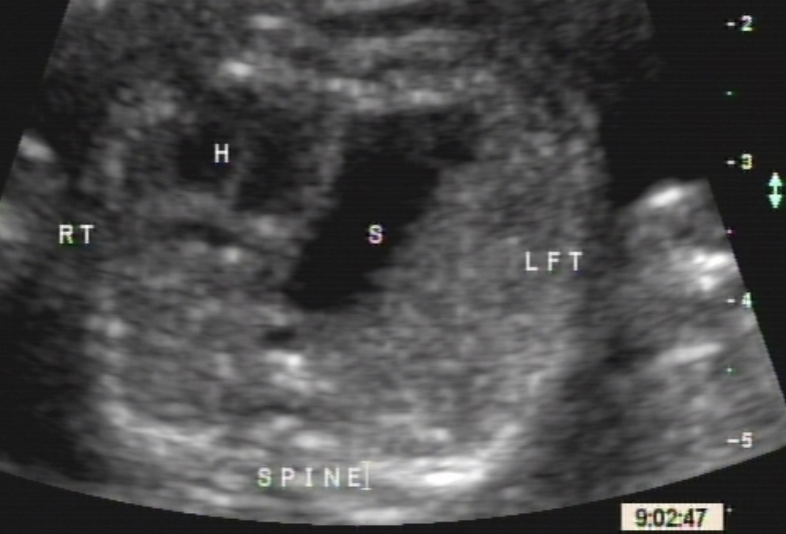 <ul><li><p><strong>herniation</strong> of abdominal viscera into chest</p></li><li><p>rarely bilateral</p></li></ul><p></p>