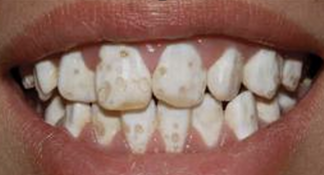 <p>De vorming zelf is normaal maar er is een stoornis in de calcificatie. Er is iets fout gegaan bij de ameloblasten, die dit opbouwen. De vormins is goed maar er mist iets in de mineralisatie.&nbsp;</p>